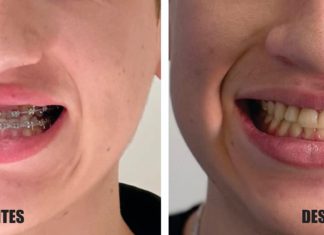 Cirugía Ortognática en Los Andes. Innovadora solución para mejorar calidad de vida de pacientes.